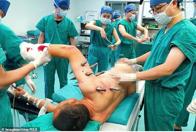 Công nhân Trung Quốc bị 10 cọc thép đâm xuyên người sau tai nạn lao động kinh hoàng - 1 Mười cọc thép đâm thủng ngực và tay bệnh nhân