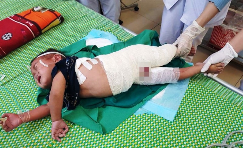 Ngã vào nồi nước luộc măng, cháu bé 2 tuổi bị bỏng nặng - Ảnh 1. Ngã vào nồi nước luộc măng, cháu bé 2 tuổi bị bỏng nặng - Ảnh 1.