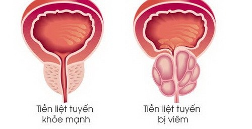 Nam giới bị đau khi yêu, đâu là thủ phạm? - 1 Viêm tuyến tiền liệt - Một nguyên nhân khiến nam giới đau khi yêu.
