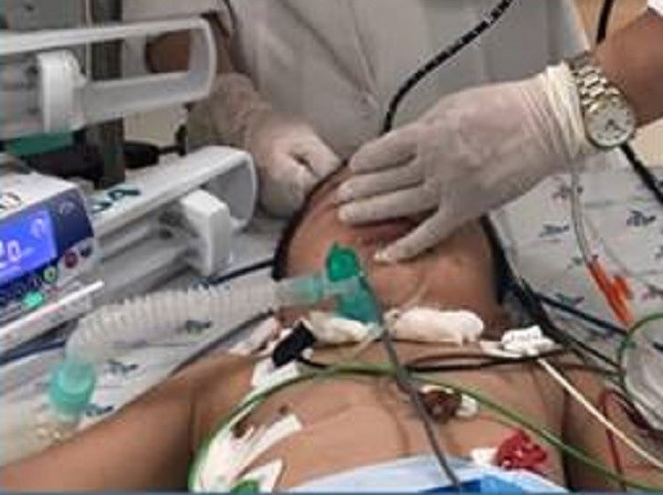 Bé 3 tuổi ngưng tim, ngưng thở vì hóc hạt mãng cầu - Ảnh 1. Bé 3 tuổi ngưng tim, ngưng thở vì hóc hạt mãng cầu - Ảnh 1.