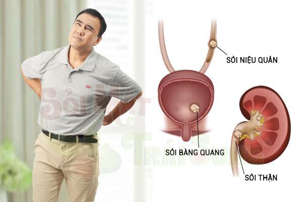Bí quyết giúp bạn đối phó với bệnh sỏi thận hiệu quả - Ảnh 1. Bí quyết giúp bạn đối phó với bệnh sỏi thận hiệu quả - Ảnh 1.