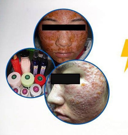 Rùng mình gương mặt như mảng cơm cháy của nữ sinh 19 tuổi sau chữa mụn tại spa - 1 Rùng mình gương mặt như mảng cơm cháy của nữ sinh 19 tuổi sau chữa mụn tại spa - 1