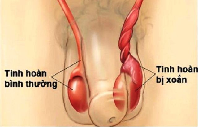 Hai thiếu nhi 13 tuổi phải cắt bỏ tinh hoàn sau 3 ngày bị sưng đau - Ảnh 1. Hai thiếu nhi 13 tuổi phải cắt bỏ tinh hoàn sau 3 ngày bị sưng đau - Ảnh 1.