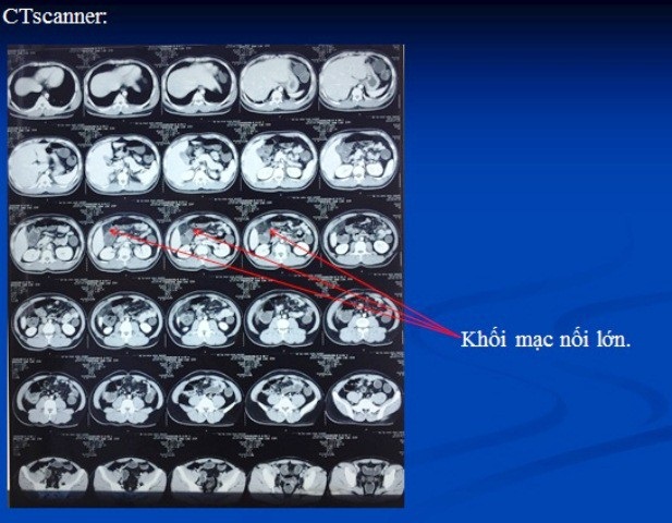 Đau bụng âm ỉ, nam thanh niên tá hỏa khi thấy mạc nối lớn xoắn như lò xo trong bụng - Ảnh 2. Đau bụng âm ỉ, nam thanh niên tá hỏa khi thấy mạc nối lớn xoắn như lò xo trong bụng - Ảnh 2.