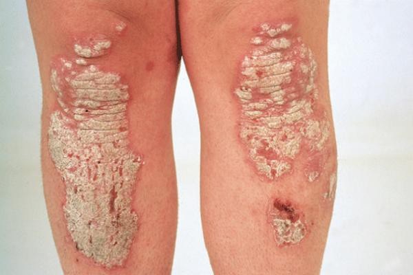 Bệnh vảy nến có lây không? Nguyên nhân gây bệnh là gì? - Ảnh 1. Bệnh vảy nến có lây không? Nguyên nhân gây bệnh là gì? - Ảnh 1.