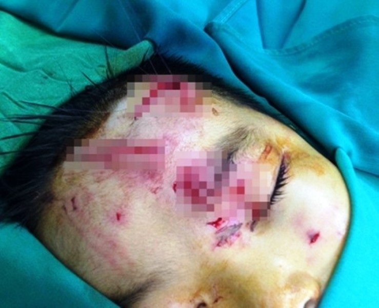 Bị chó nhà tấn công, bé trai 7 tuổi nguy kịch - Ảnh 1. Bị chó nhà tấn công, bé trai 7 tuổi nguy kịch - Ảnh 1.