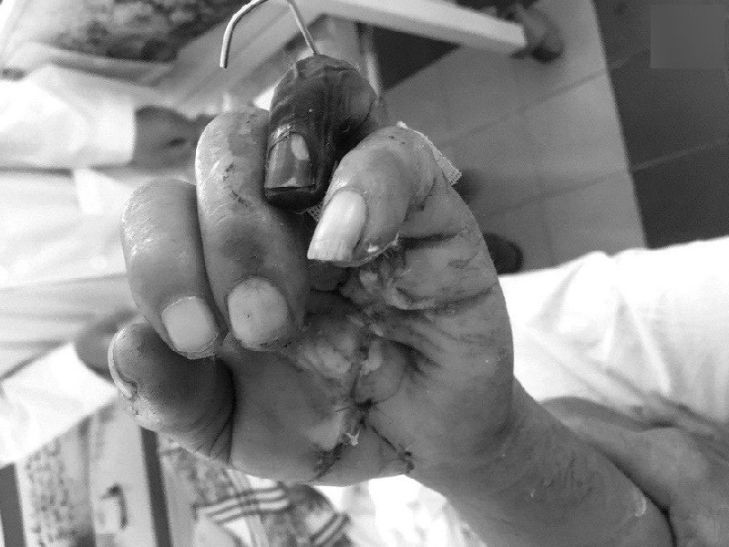 Thợ mộc bị máy cưa cắt lìa bàn tay - Ảnh 1.