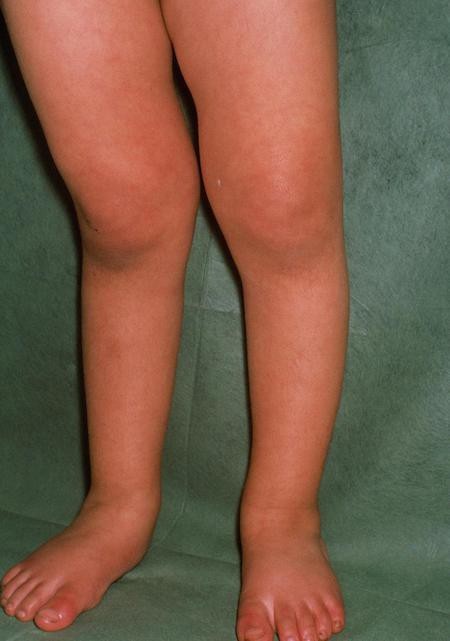 Bố mẹ hầu tòa vì bắt con ăn chay dẫn đến suy dinh dưỡng nặng - Ảnh 1. Bố mẹ hầu tòa vì bắt con ăn chay dẫn đến suy dinh dưỡng nặng - Ảnh 1.