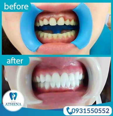 Tìm hiểu kỹ trước khi bọc răng sứ kẻo tiền mất tật mang - Ảnh 5. Tìm hiểu kỹ trước khi bọc răng sứ kẻo tiền mất tật mang - Ảnh 5.