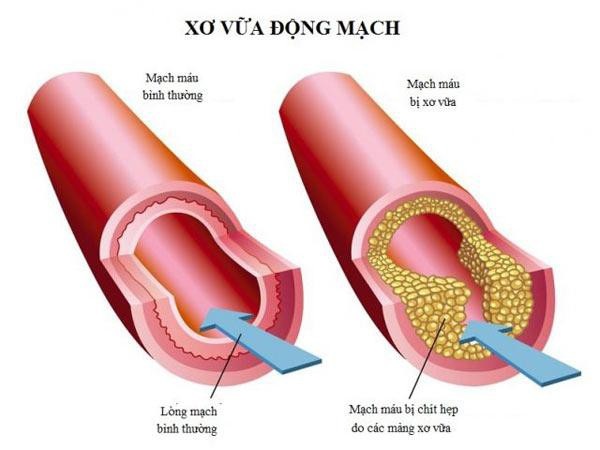 Biến chứng xơ vữa động mạch do rối loạn lipid máu nguy hiểm ra sao? - 2 Mạch máu bị xơ vữa do rối loạn lipid máu không được điều trị