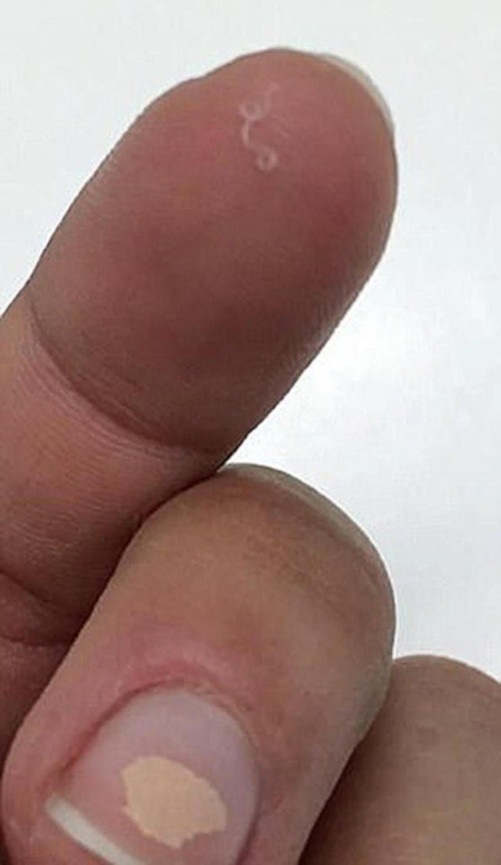 Cô gái xinh đẹp bị 14 con giun sống ký sinh trong mắt - 2 Abby chụp lại ảnh con giun lấy ra từ mắt