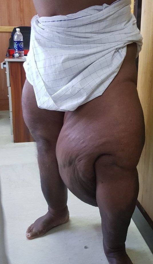 Số phận thay đổi, phải nằm liệt giường sau một lần bị muỗi đốt - 3 Số phận thay đổi, phải nằm liệt giường sau một lần bị muỗi đốt - 3