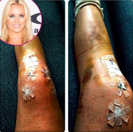 Giàu sang, nổi tiếng nhưng “sao” vẫn nhiều phen “trầy da tróc vảy” - 8 Bị thương khi thi đấu, Lindsey Vonn đã phải trải qua ca phẫu thuật hồi phục hết sức phức tạp và lưu lại những dấu vết kinh hoàng đến nhường này.