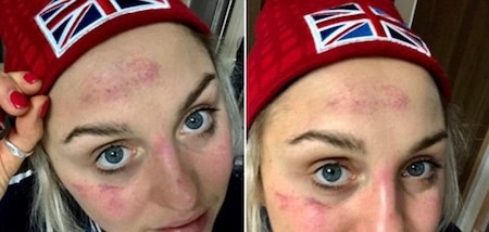 Nữ vận động viên xinh đẹp “khoe” gương mặt bầm dập tại Olympic mùa Đông - 1 Aimee Fuller thực sự đã bầm dập vì Olympic mùa đông