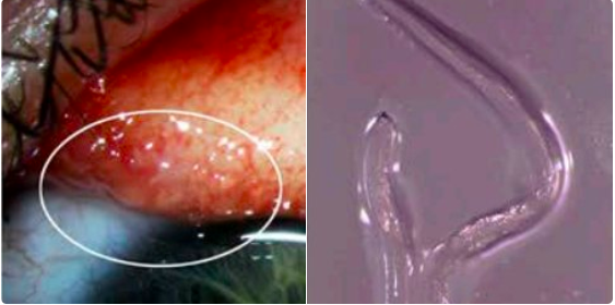 
Trường hợp nhiễm giun ký sinh Thelazia gulosa ở mắt, trước đây được cho là chỉ có trên động vật
