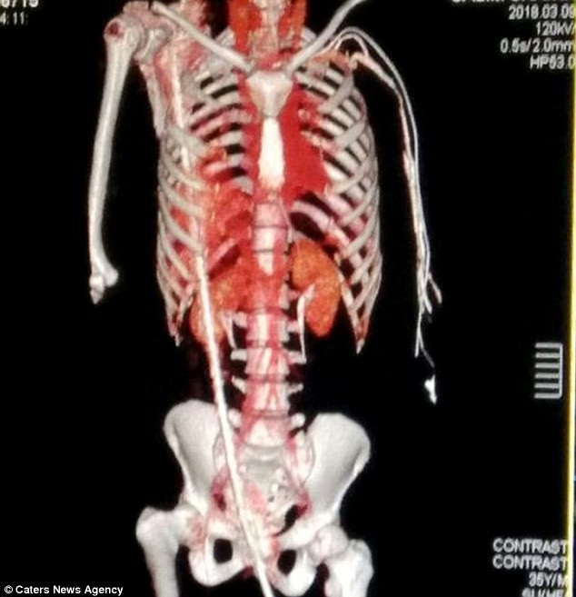 Thoát chết thần kỳ sau khi bị thanh thép hơn 1,3m đâm xuyên người - 2 Bác sĩ ai cũng sốc khi thấy tình trạng của Salim