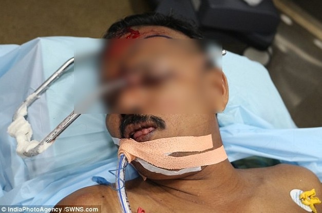 Bị thanh thép đâm xuyên hộp sọ, người đàn ông sống sót thần kỳ - 1
Thanh thép đâm xuyên đầu Ullas