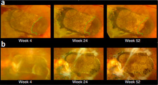 Ảnh chụp đáy mắt cho thấy các tế bào mới sẫm màu hơn đã mọt lên quanh miếng dán sau một năm.