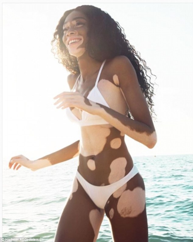 
Winnie Harlow là siêu mẫu bạch biến đình đám thế giới. Dù sở hữu làn da loang màu nhưng Winnie Harlow vẫn rất tự tin, quyến rũ
