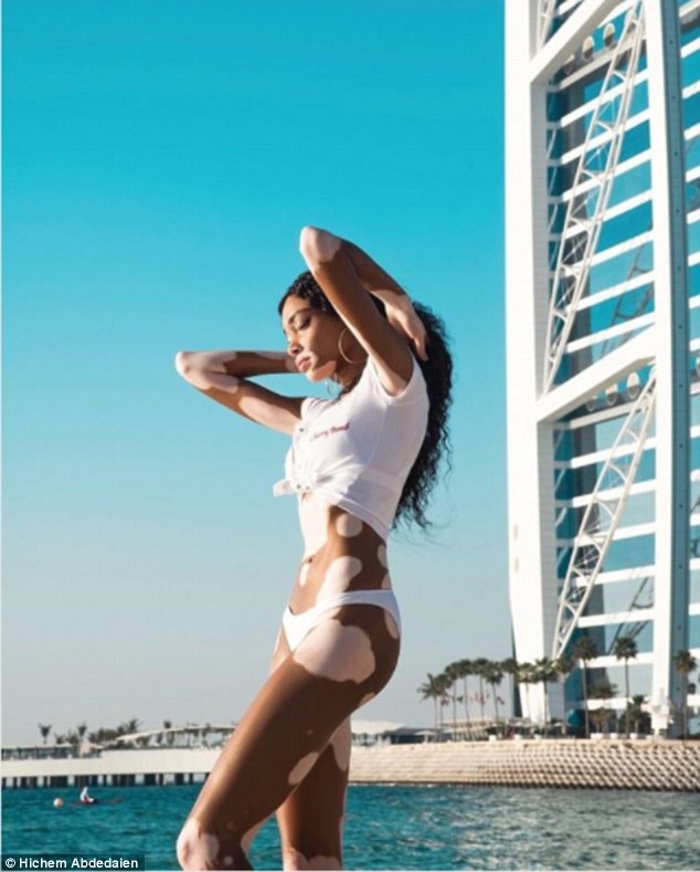 
Dù không giành chiến thắng cao nhất nhưng Winnie Harlow vẫn rất nổi tiếng
