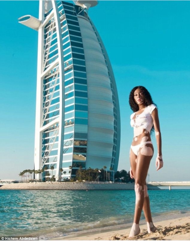 
Winnie Harlow chia sẻ, cô đã trải qua nhiều giai đoạn khó khăn trong cuộc sống, thậm chí phải nghỉ học vì bị bạn bè trêu chọc
