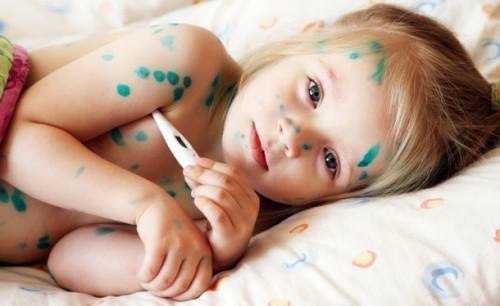 Các bậc cha mẹ không nên sử dụng các bài thuốc truyền miệng để điều trị thủy đậu cho trẻ. Ảnh: TL