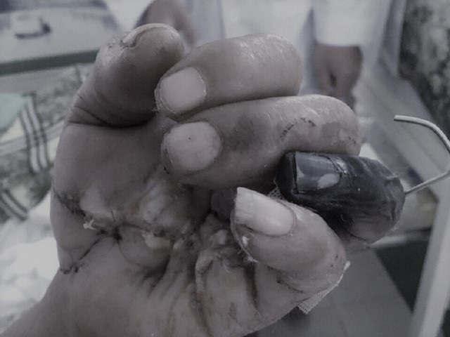 
Bàn tay của nạn nhân dù được ghép nhưng vẫn bị hoại tử ngón áp út.
