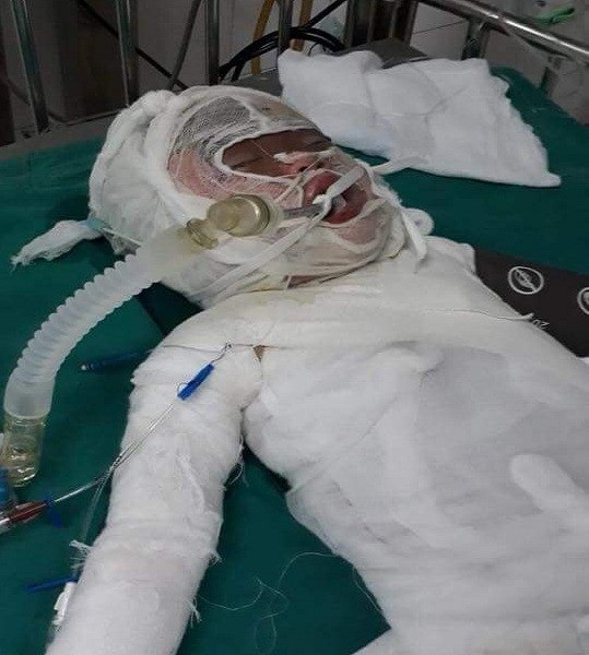 Đau đớn 2 phận người bỏng nặng nguy kịch trên giường bệnh - 3 Cháu Linh đang được điều trị tại Hà Nội. Chi phí lớn lắm, nhưng gia đình chị Hoa không biết lấy đâu ra để tiếp tục chữa trị cho con trong thời gian tới.