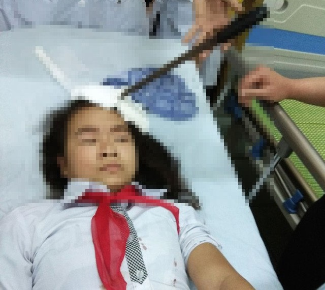 Bộ GD&ĐT yêu cầu xử lý nghiêm học sinh phi dao vào trán bạn - 1 Cháu Nguyễn Thị Hà lúc mới nhập viện trong tình trạng dao cắm vào trán (ảnh: báo Hà Nam)