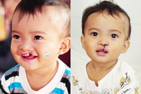 Miễn phí phẫu thuật sứt môi, hở hàm ếch cho trẻ nghèo miền Trung – Tây Nguyên - 1 Dự án “Nụ cười nhân ái” sẽ phẫu thuật sứt môi, hở hàm ếch, lệch lỗ tiểu miễn phí cho trẻ em nghèo khu vực miền Trung - Tây Nguyên