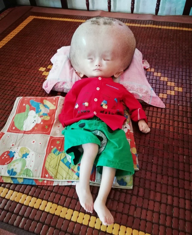 Đáng thương bé 3 tuổi đầu to dần như bong bóng - 1 Cháu Nguyễn Minh Hiếu, 3 tuổi, mắc phải chứng bệnh não úng thủy.