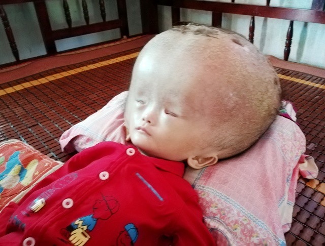 Đáng thương bé 3 tuổi đầu to dần như bong bóng - 2 Đáng thương bé 3 tuổi đầu to dần như bong bóng - 2