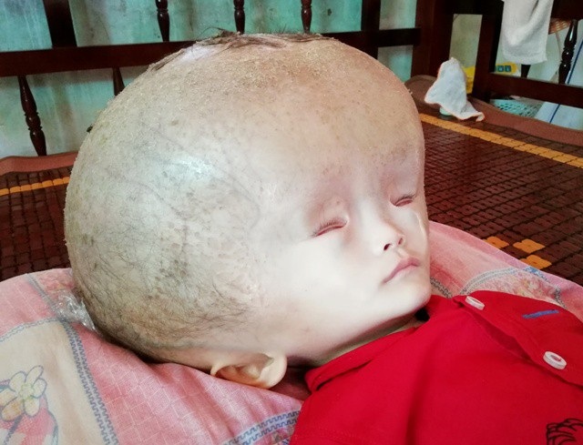 Đáng thương bé 3 tuổi đầu to dần như bong bóng - 3 Căn bệnh khiến đầu cháu Hiếu to khác thường.