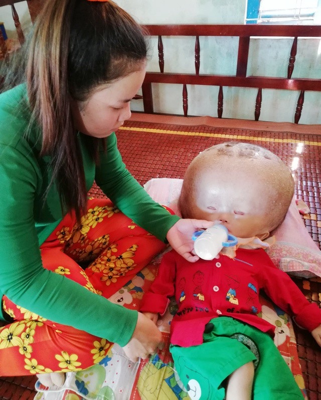 Đáng thương bé 3 tuổi đầu to dần như bong bóng - 4 Đáng thương bé 3 tuổi đầu to dần như bong bóng - 4