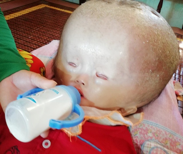 Đáng thương bé 3 tuổi đầu to dần như bong bóng - 5 Cháu bé thức uống sữa, với đôi mắt mở mà cũng như đang nhắm lại.