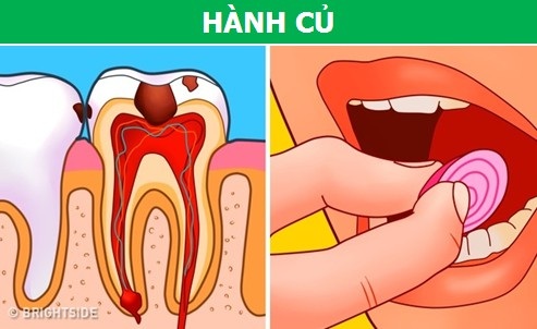 Những phương pháp cực đơn giản giúp làm dịu cơn đau răng tức thì - 7 Những phương pháp cực đơn giản giúp làm dịu cơn đau răng tức thì - 7