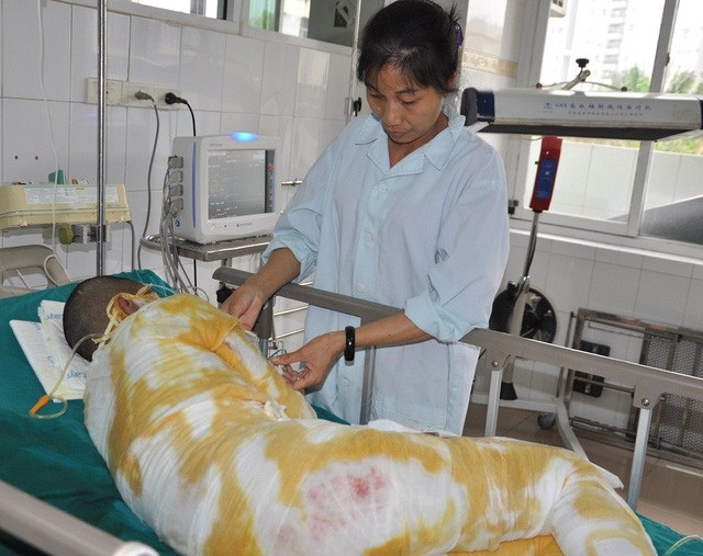 Gần 214 triệu đồng đến với em Mơ bỏng nặng vì lao vào cứu bạn - 1 Bị bỏng nặng do lao vào cứu bạn, Mơ được điều trị tích cực tại Viện bỏng quốc gia suốt thời gian qua.