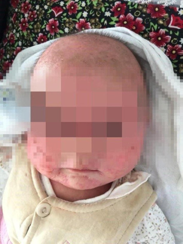 Câu chuyện đau lòng cảnh báo về "nụ hôn của mẹ" khi chăm sóc trẻ - 2 Sau một thời gian nhập viện, cậu bé đã gần khỏi bệnh