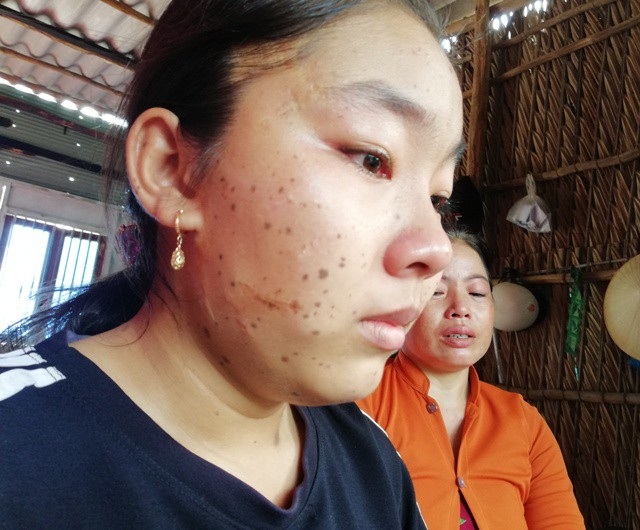Khốn khổ bé gái lớp 8 mắc bệnh rối loạn sắc tố da - 7 Gia đình đã cố gắng điều trị cho cháu, nhưng cũng chỉ có thể tạm xử lý ở vùng mặt để cháu dễ nhìn hơn một chút.