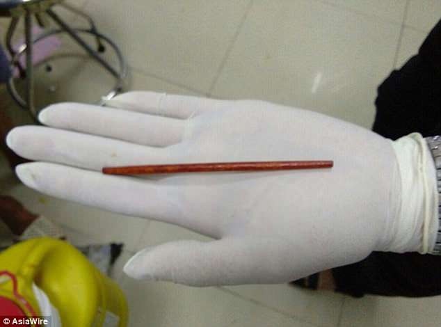 Chiếc đũa dài 10cm được lấy ra từ ống niệu đạo của bệnh nhân 42 tuổi.