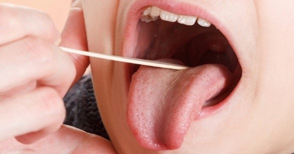 4 nguyên nhân dẫn đến lưỡi màu cam - 1 4 nguyên nhân dẫn đến lưỡi màu cam - 1