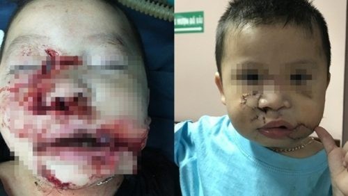 Hà Nội: Bé 2 tuổi bị chó nhà cắn nát mặt - 1 Bệnh nhi trước và sau khi được phẫu thuật tạo hình (Ảnh: Bs cung cấp)