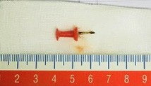 Đinh ghim sắt chui tọt vào phế quản bé gái 12 tuổi - 2 Đinh ghim sắt chui tọt vào phế quản bé gái 12 tuổi - 2