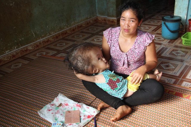 Bé gái Ê đê bị não úng thủy nặng đã ra đi mãi mãi - 1 Bé HXíu Ê ban bị bệnh não úng thủy nặng khi còn sống