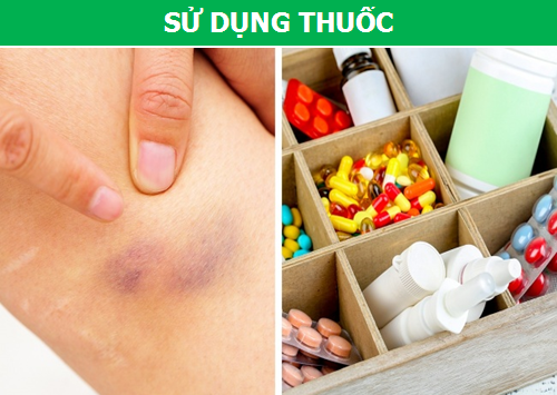 Nguyên nhân sâu xa đằng sau những vết bầm tím xuất hiện khó hiểu trên da - 2 Nguyên nhân sâu xa đằng sau những vết bầm tím xuất hiện khó hiểu trên da - 2