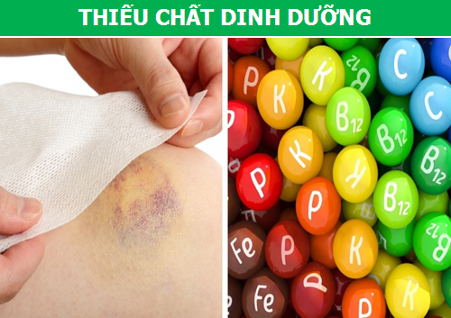 Nguyên nhân sâu xa đằng sau những vết bầm tím xuất hiện khó hiểu trên da - 4 Nguyên nhân sâu xa đằng sau những vết bầm tím xuất hiện khó hiểu trên da - 4