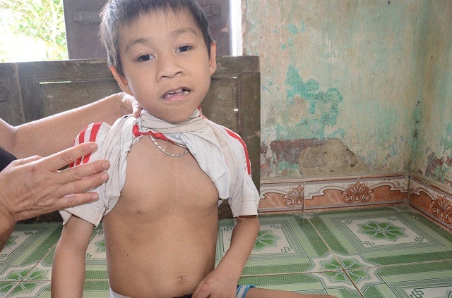 Gia cảnh khốn cùng của bé 9 tuổi, mắc đa dị tật bẩm sinh - 4 Em đã phải trải qua ca phẫu thuật tim.