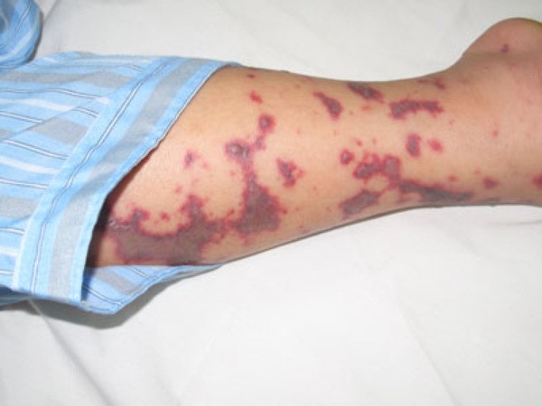 Bệnh nhân bị não mô cầu với các ban hoại tử điển hình trên da. Ảnh: H.Hải