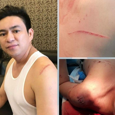 Phía sau bản hợp đồng thuê giang hồ truy sát bác sĩ Chiêm Quốc Thái - 2 Bác sĩ Thái thời điểm bị truy sát với vết thương khâu 20 mũi trên vai.