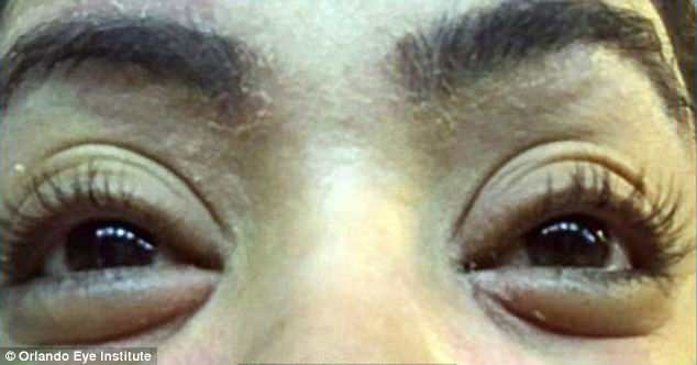 Nối mi, 12 phụ nữ bị bọ ve bám trên mí mắt - 2